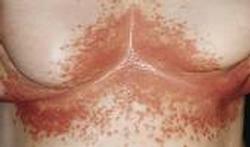 skin candida candidia-huid-170_400_01.jpg