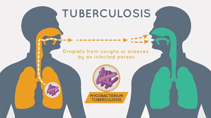 Tubrculosis