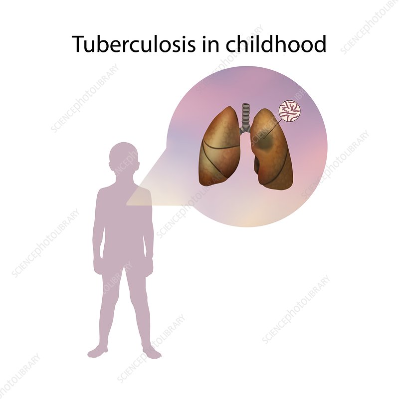 tuberculosis in kids